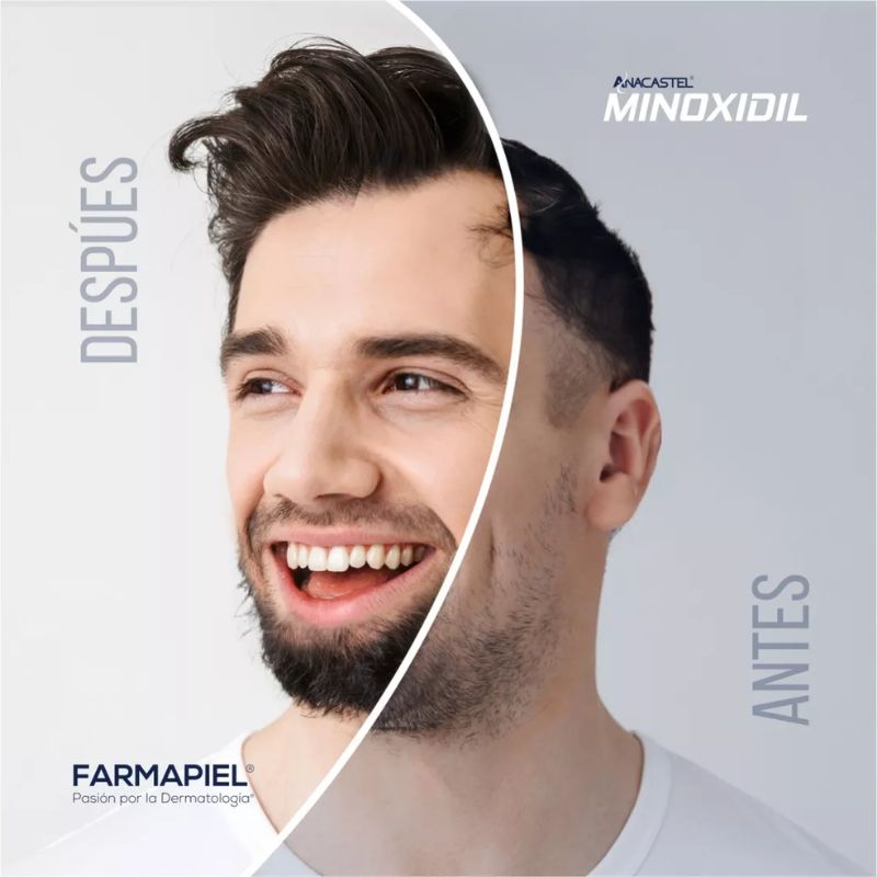 Minoxidil 5% Anacastel 3 Pack (60 ml c/u)